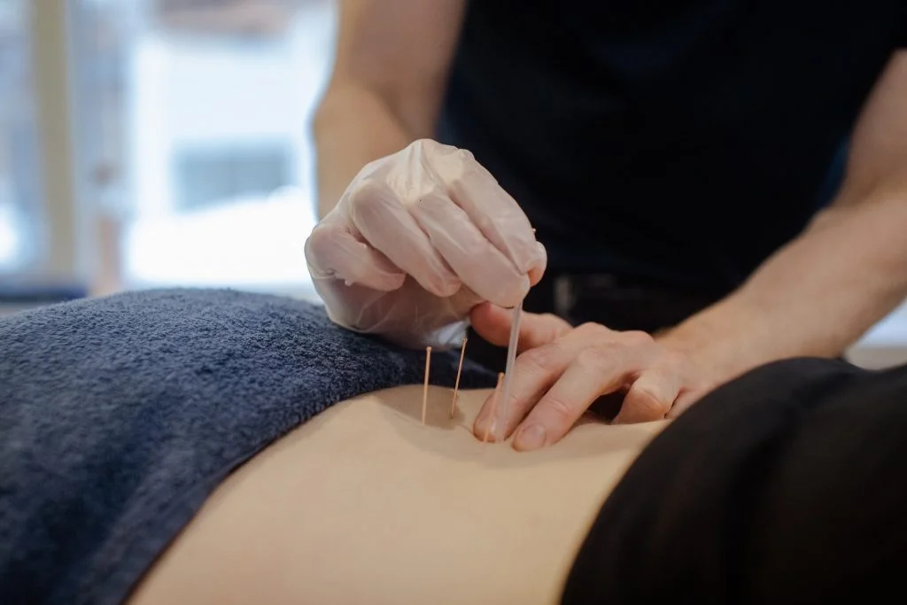 Dry Needling Eastern Suburbs Sydney