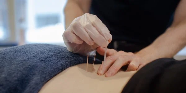 Dry Needling Bondi Junction Eastern Suburbs